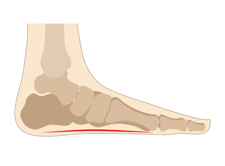 Flat Foot