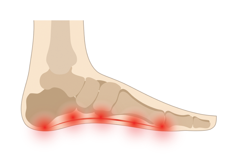 Plantar Fascitiis